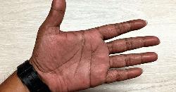 গ্রীষ্মেও এভাবে হাতের চামড়া উঠছে?
